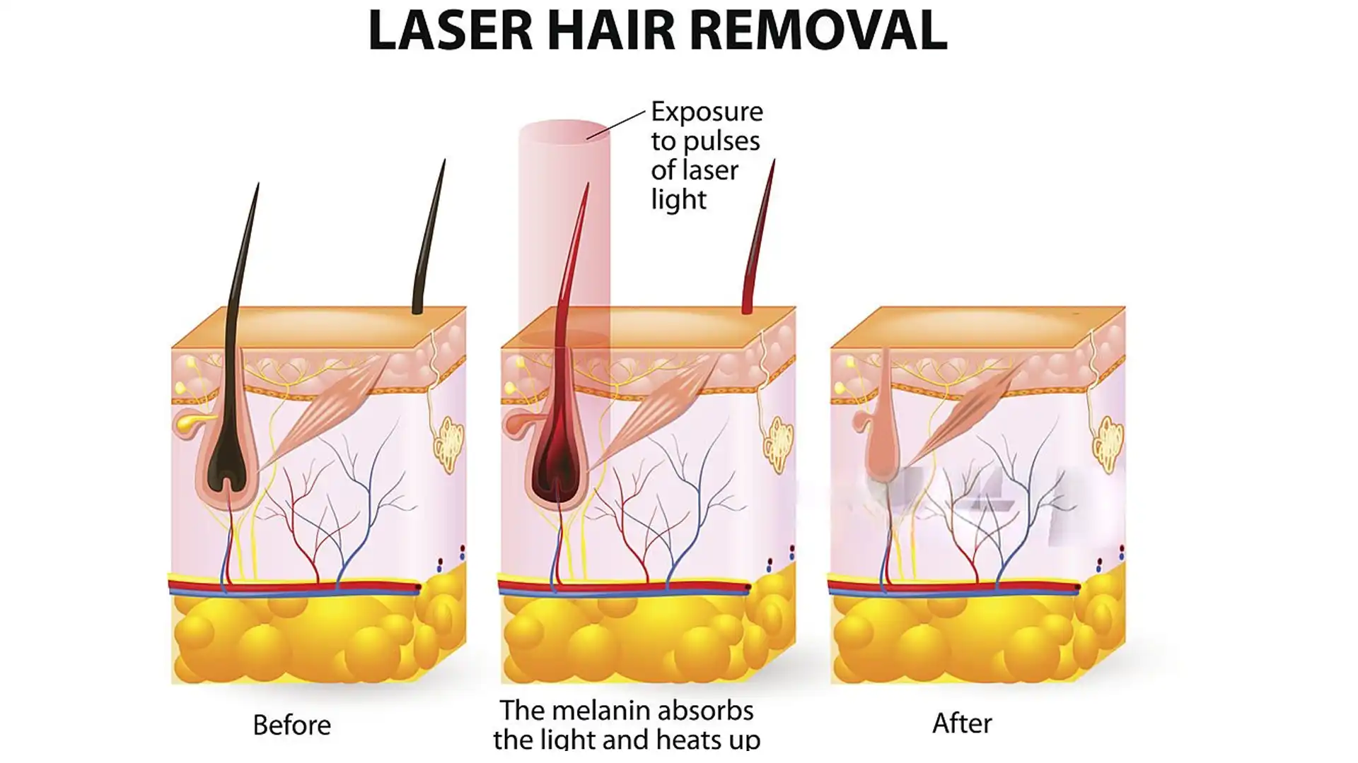 What is Laser Hair Removal and How Does It Work