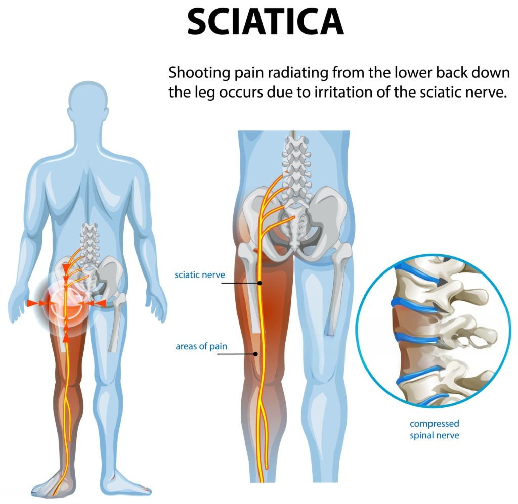 What is Sciatica Pain?